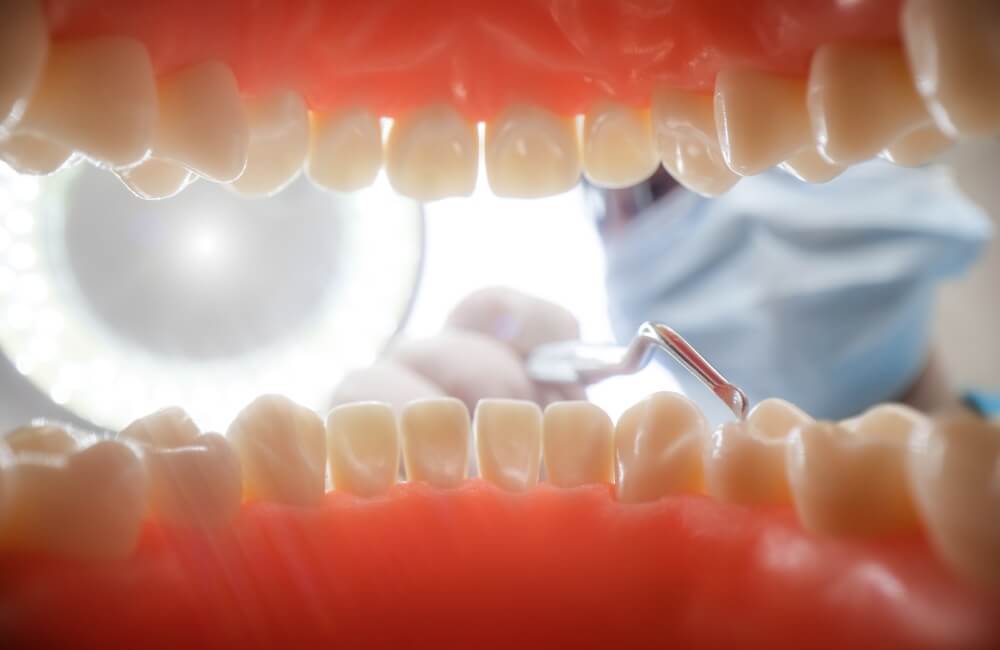 Problemas de los implantes dentales
