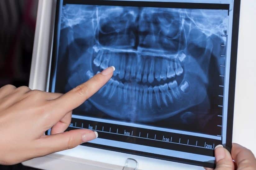 cuántas radiografías dentales se pueden hacer al año sin riesgos