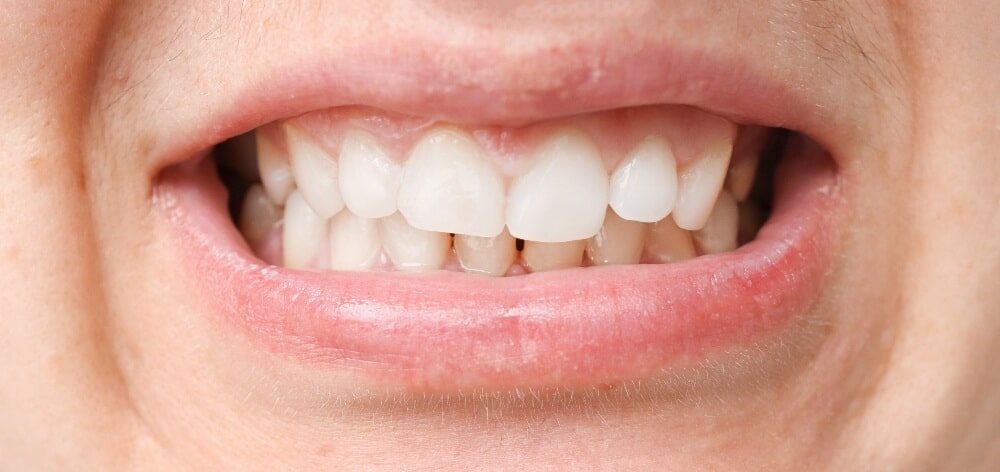 Cómo se hace el curetaje dental y qué beneficios tiene