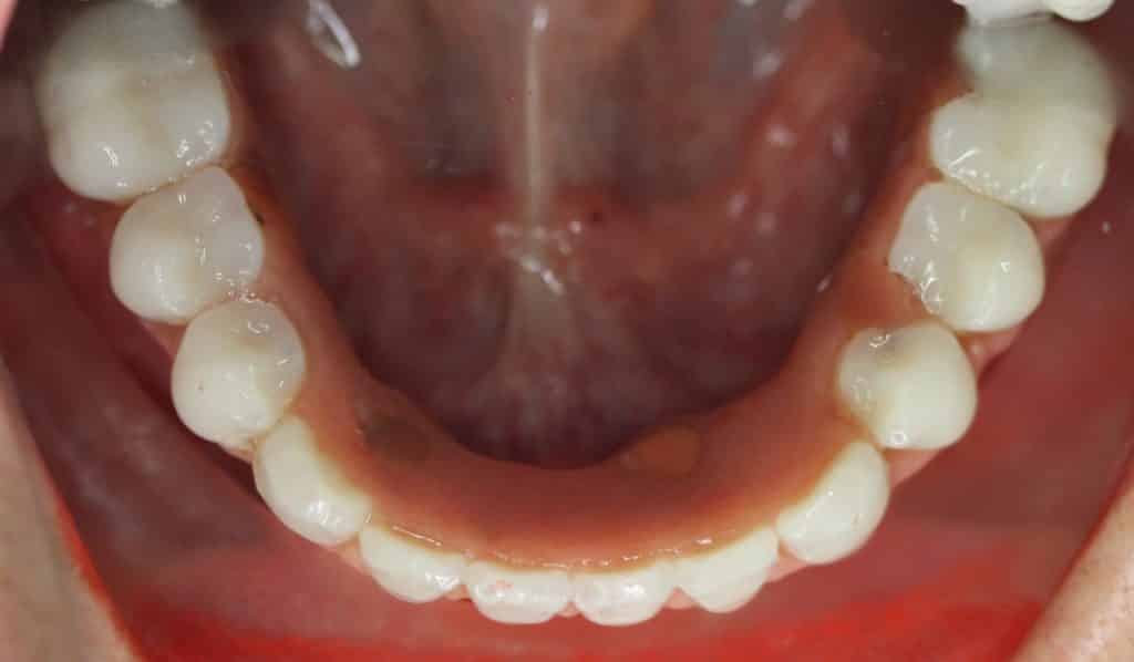 Casos complejos en la Clínica Dental González Baquero: rehabilitación de carga inmediata