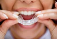 Descubre la ortodoncia invisible antes y después