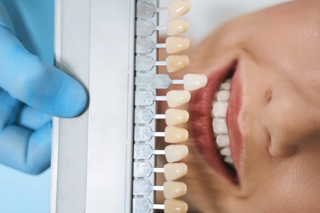 Cuidado y mantenimiento de las carillas dentales