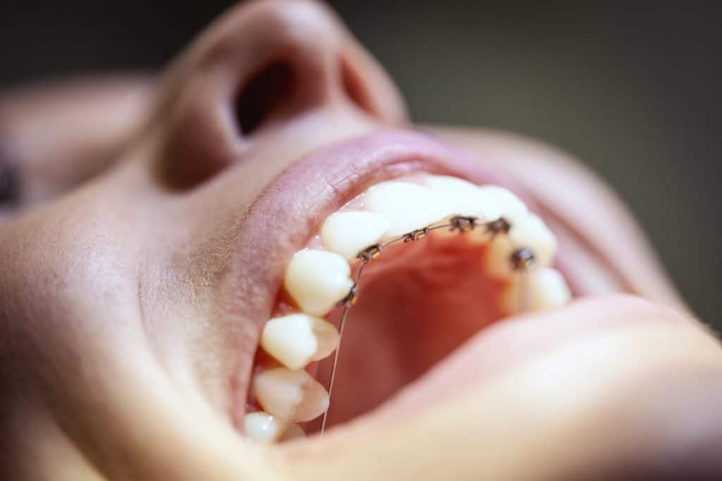 Aprende todo sobre la ortodoncia lingual. ¿Qué es y cuándo se utiliza?