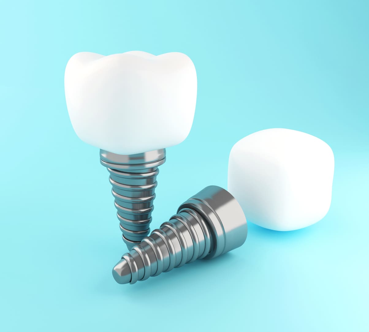 ¿Cuáles son las partes de un implante dental?