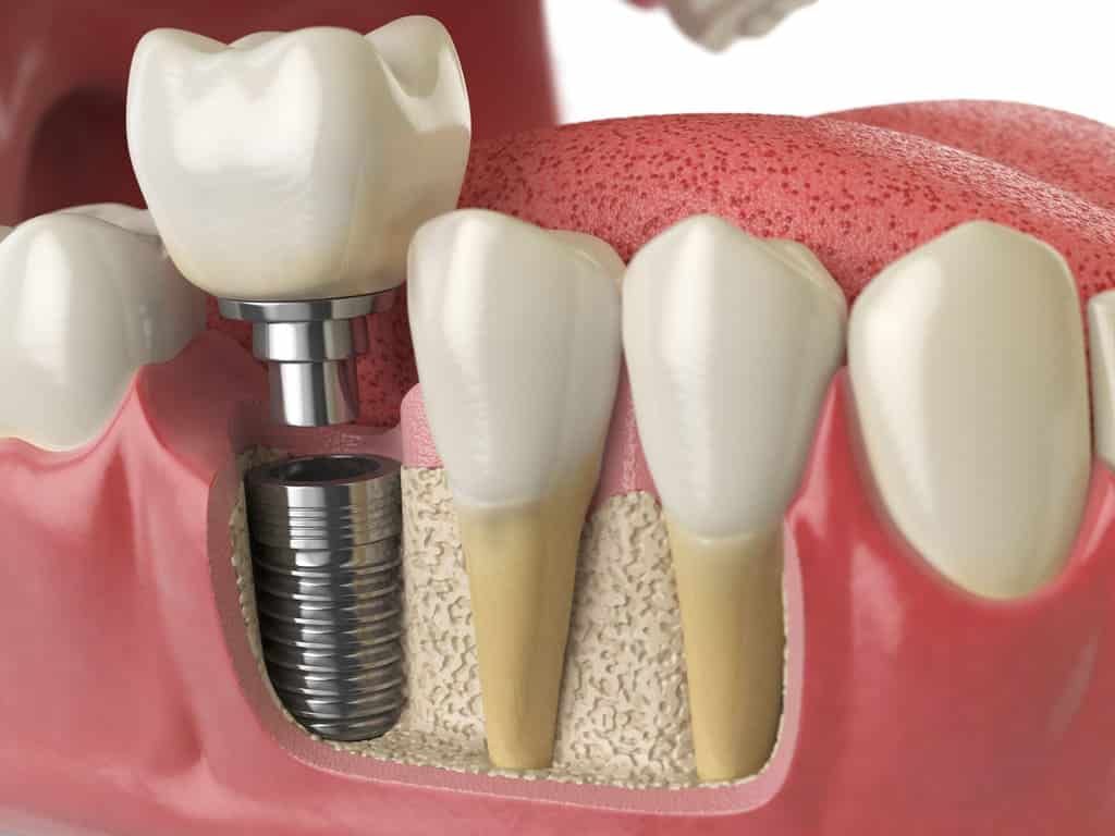 partes del implante dental