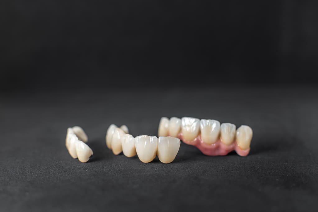 ejemplos de coronas dentales