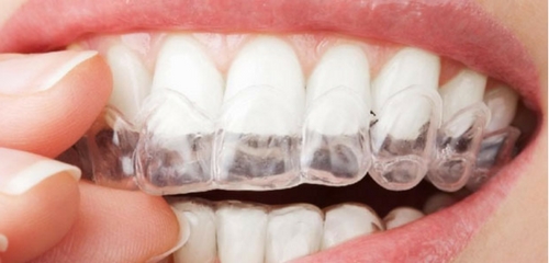 ¿Puedo llevar ortodoncia invisible si tengo implantes?