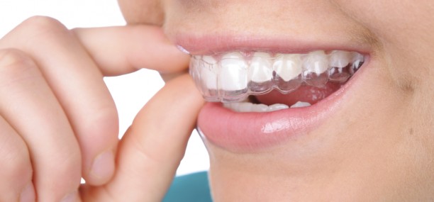 Invisalign: los secretos de la ortodoncia invisible