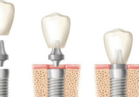 Precio de implantes dentales en Madrid