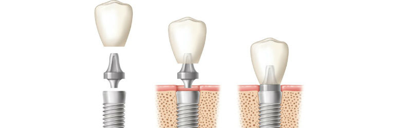 Precio de implantes dentales en Madrid ¿De qué depende?