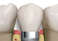 La osteointegración en los implantes dentales