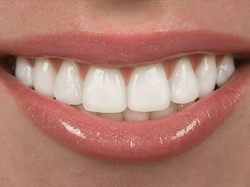 El limado de dientes para mejorar la estética dental